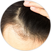 Hair Loss Hair Loss